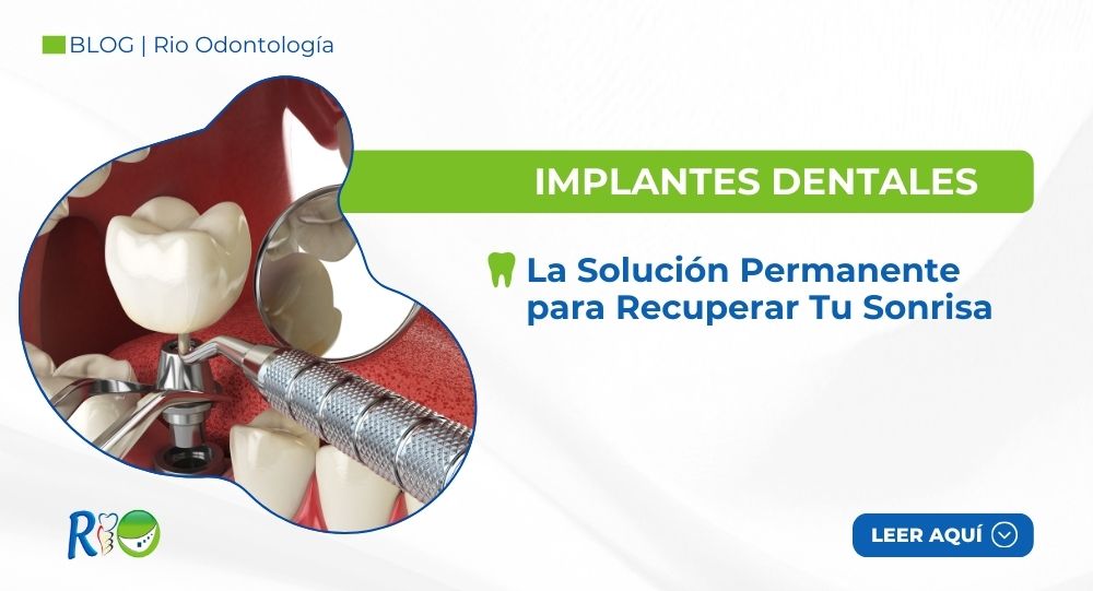 Implantes Dentales: La Solución Permanente para Recuperar Tu Sonrisa