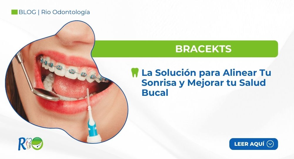 Brackets: La Solución para Alinear Tu Sonrisa y Mejorar tu Salud Bucal